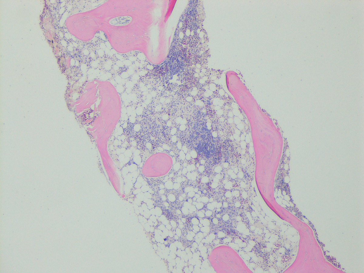 Bone marrow biopsy: H&E, low power